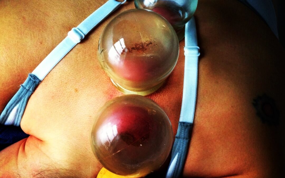 Cupping & Scraping | Communications